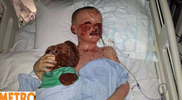 Bimbo di 6 anni rischia la vita per la tonsillite: "Il suo corpo sembrava bruciare dall'interno"