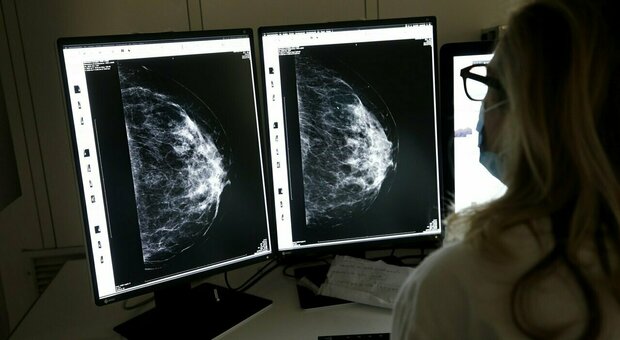 Tumore al seno, nuovo monoclonale più efficace della chemio: riduce rischio di morte del 36%