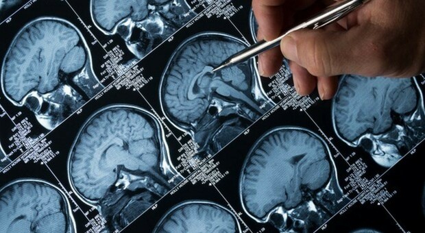 Alzheimer, autorizzato negli Usa nuovo farmaco che rallenta il declino cognitivo. «Svolta epocale»