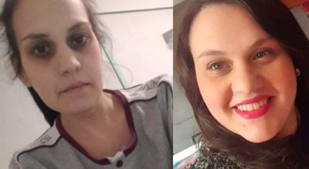 Speranza per Angela, la mamma 29enne grave dopo due interventi per dimagire: sarà operata con tecnologia 3D