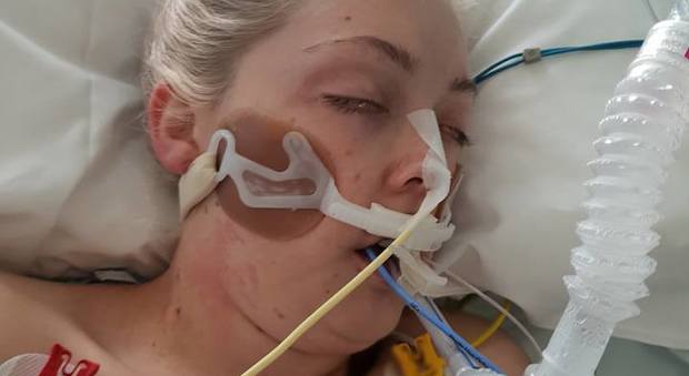 «Ecco come l'ha ridotta la droga», la foto choc della sorella di una 24enne morta per overdose