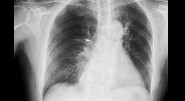 Ha una vite nei polmoni e non lo sa: la radiografia la scopre per caso
