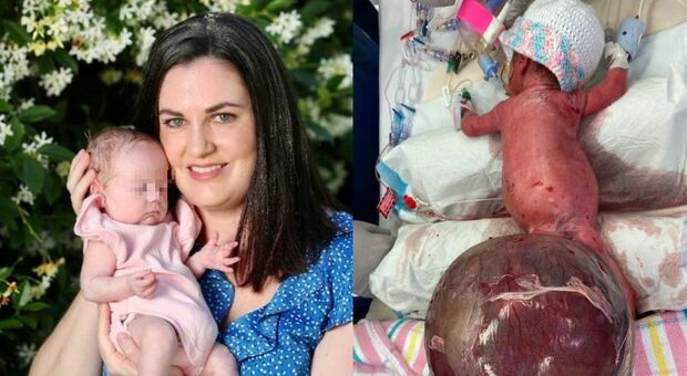 Nasce prematura con un tumore che è il doppio del suo peso, l'incredibile intervento per salvare la vita alla neonata
