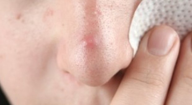 Brufoli interni al naso, invisibili ma molto più dolorosi: ecco tutti i possibili rimedi