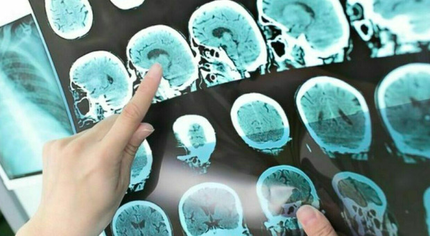 Un legame tra influenza, Alzheimer e Parkinson? «Rischio elevato di malattie neurogenerative»