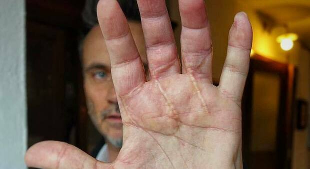 Nek mostra le cicatrici sulla mano dopo l'incidente: «Il corso della vita può cambiare in un secondo»