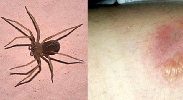 Morsa dal ragno velenoso mentre dorme: 25enne rischia un intervento