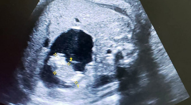 Bimba nasce con il feto della gemellina in grembo: il caso rarissimo, com'è accaduto