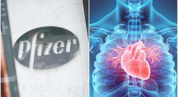 Pfizer, la miocardite tra gli effetti collaterali: quando si verifica? I sintomi da controllare
