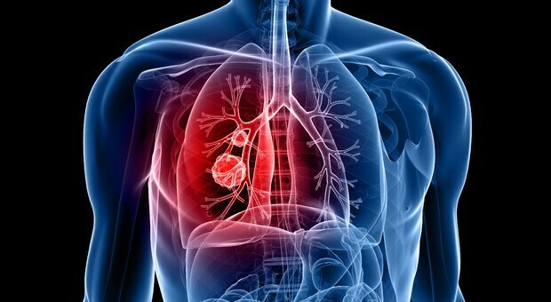 Cancro al polmone, la scoperta: «In chi non ha mai fumato mutazioni diverse dai fumatori»