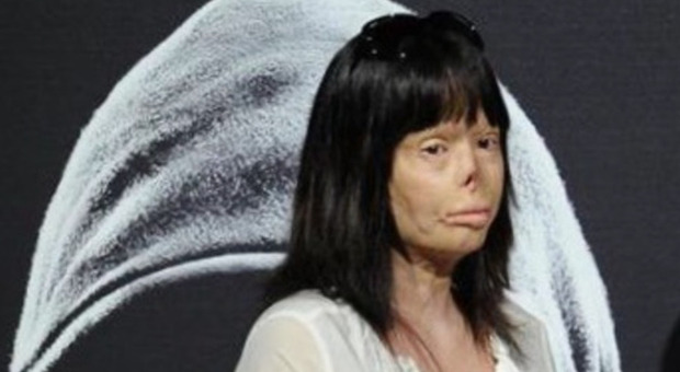 Valentina Pitzalis, la 27enne sfigurata dall'ex marito a Verissimo: «Ho bruciato per 20 minuti, speravo di morire»