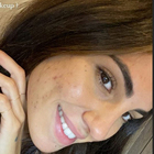 Giulia De Lellis e il primo piano con l'acne sui social: «Senza filtri è una storia diversa»