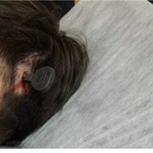 Napoli: rissa al campo di calcio, 12enne in ospedale con una chiave infilzata in testa FOTO