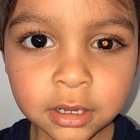 Mamma nota uno strano riflesso nell'occhio del figlio: il piccolo ha un cancro alla retina