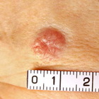 Valentina Ferragni e il tumore alla pelle: ecco cos'è il basalioma e come prevenirlo