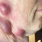 Febbre alta e rigonfiamenti sul viso, è la «febbre dei conigli»: uomo contagiato da un gatto