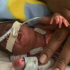 Bimbo nato prematuro più piccolo del mondo