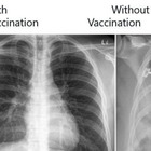 Covid, gli effetti sui polmoni in chi è vaccinato e chi no