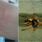 Punta da una vespa, donna muore per choc anafilattico: aveva 63 anni