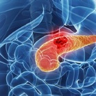 Tumore al pancreas, diagnosi possibile fino a tre anni prima: la scoperta dei ricercatori dell'Università di Oxford