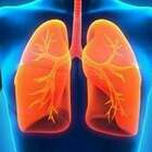 Tumore al polmone, trovate le cause nei non fumatori: passo chiave per terapie personalizzate