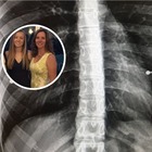 La figlia nasconde un segreto, madre scopre tutto dopo una radiografia: «Era visibilmente turbata»